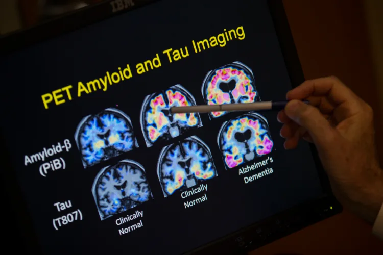 Want to lower your risk of dementia? It doesn't involve a blood test
